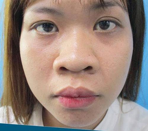 6 đặc điểm giàu sang chỉ có ở người có tướng mũi to 12 Không chỉ ảnh hưởng diện mạo mà tướng số cũng không mấy tốt đẹp