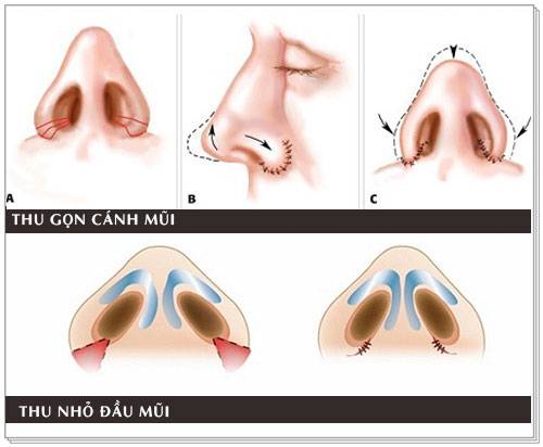 6 đặc điểm giàu sang chỉ có ở người có tướng mũi to 15 Cắt hay cuộn cánh mũi dựa vào trạng thái cánh mũi to của từng khách hàng