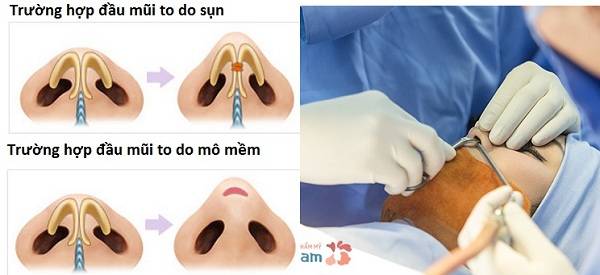 6 đặc điểm giàu sang chỉ có ở người có tướng mũi to 16 Mô phỏng kĩ thuật thu nhỏ đầu mũi với từng trường hợp
