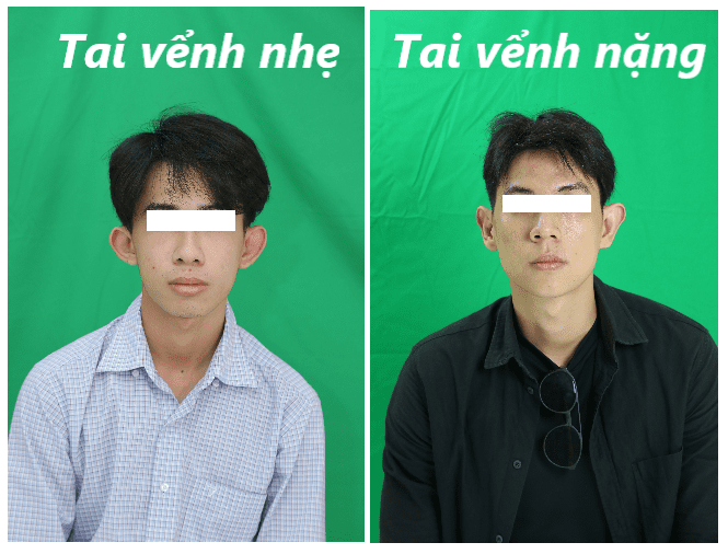 Người có tướng tai vểnh tốt hay xấu? Xem vận mệnh đúng 100% 7 Đối với đàn ông có tướng tai vểnh