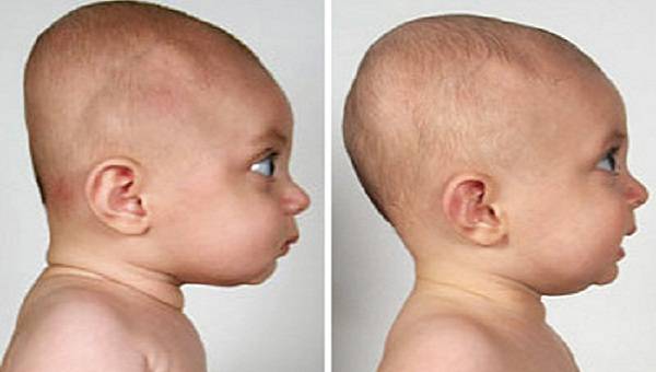 Tướng đầu sọ khỉ là gì? Tướng đầu sọ khỉ có nguy hiểm không? 4 Tại sao lại có tướng đầu sọ khỉ ở trẻ em